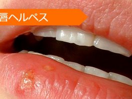 口唇ヘルペス アシクロビル バラシクロビル