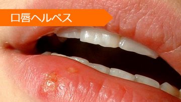 口唇ヘルペス アシクロビル バラシクロビル