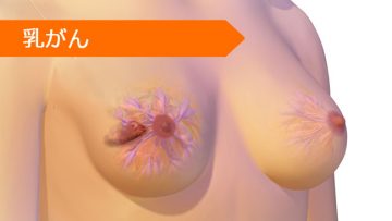 パクリタキセル ドセタキセル タモキシフェン エキセメスタン レトロゾール エピルビシン アナストロゾール