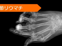 リツキシマブ レフルノミド