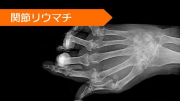 リツキシマブ レフルノミド