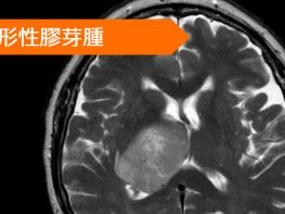 膠芽腫 ベバシズマブ ベバシズマブ
