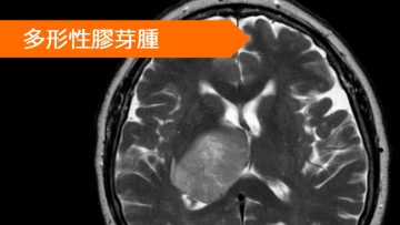 膠芽腫 ベバシズマブ ベバシズマブ