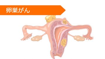 カルボプラチン