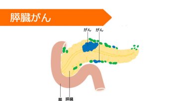 ゲムシタビン
