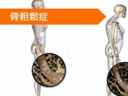 オキサンドロロン テリパラチド
