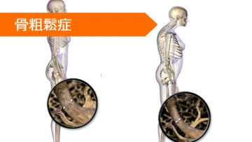 オキサンドロロン テリパラチド