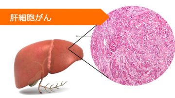 ソラフェニブ