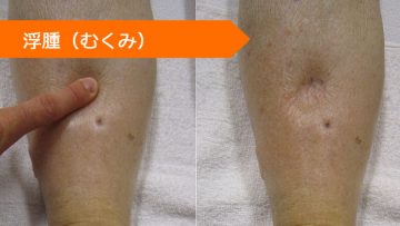 トリアムテレン