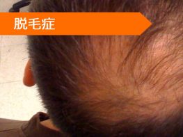 トリアムシノロン ミノキシジル