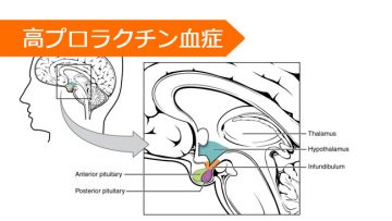 ブロモクリプチン
