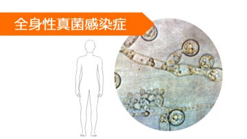 ベリコナゾール