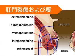 ニトログリセリン